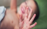 [ẢNH] Những loại bệnh dịch phổ biến do thời tiết ở Việt Nam